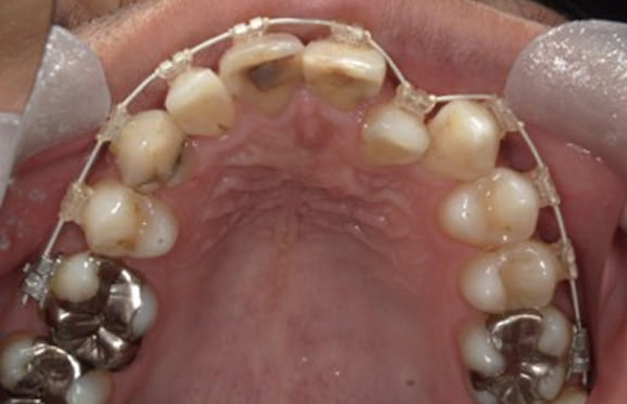 藤沢デンタルオフィスの虫歯や破折で抜歯後の部分矯正