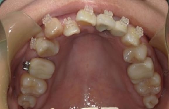 藤沢デンタルオフィスの虫歯や破折で抜歯後の部分矯正