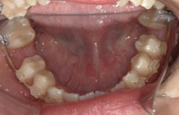 藤沢デンタルオフィスの虫歯や破折で抜歯後の部分矯正