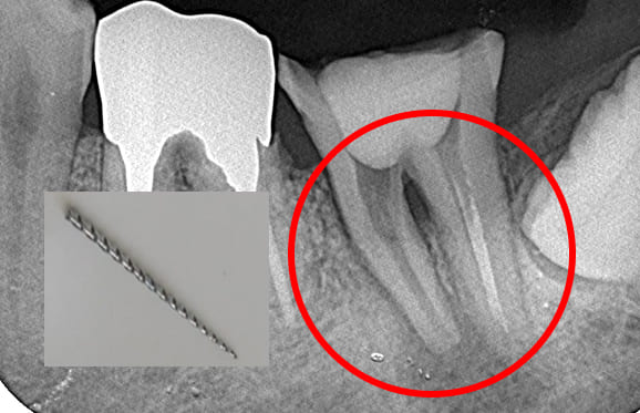 藤沢デンタルオフィスの破折ファイル除去