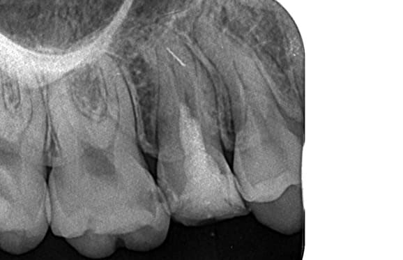 藤沢デンタルオフィスの破折ファイル除去