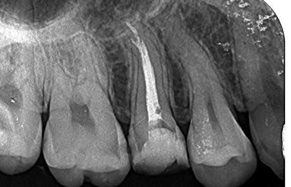 藤沢デンタルオフィスの破折ファイル除去
