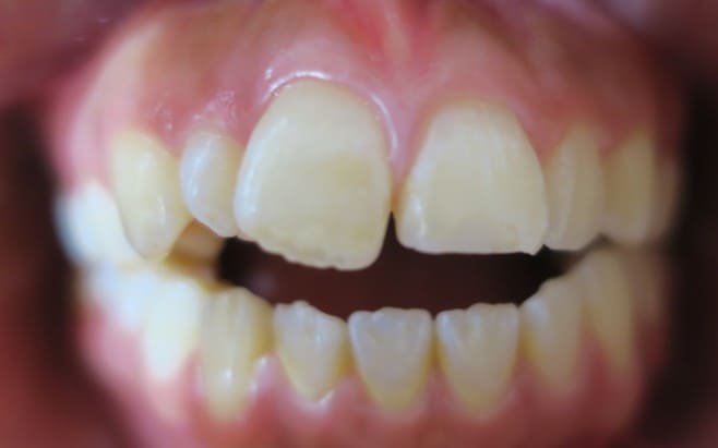 藤沢デンタルオフィスのマウスピース矯正