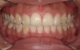 藤沢デンタルオフィスのマウスピース矯正