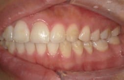 藤沢デンタルオフィスのマウスピース矯正