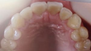 藤沢デンタルオフィスのマウスピース矯正