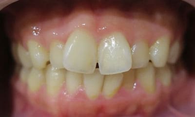 藤沢デンタルオフィスのマウスピース矯正