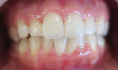 藤沢デンタルオフィスのマウスピース矯正