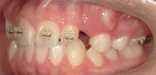 藤沢デンタルオフィスの部分矯正