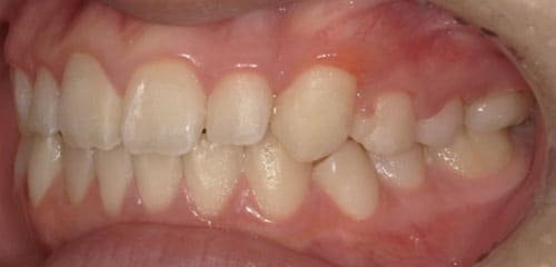 藤沢デンタルオフィスの部分矯正