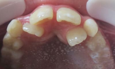 藤沢デンタルオフィスのワイヤー矯正