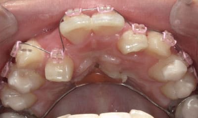 藤沢デンタルオフィスのワイヤー矯正