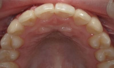 藤沢デンタルオフィスのワイヤー矯正