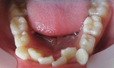 藤沢デンタルオフィスのワイヤー矯正