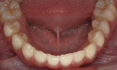 藤沢デンタルオフィスのワイヤー矯正