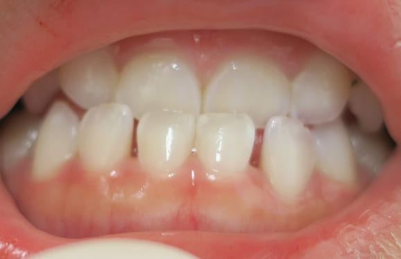 藤沢デンタルオフィスの咬み合わせ予防