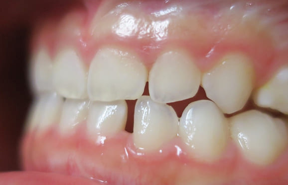 藤沢デンタルオフィスの咬み合わせ予防