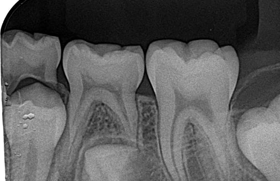 藤沢デンタルオフィスの虫歯や破折で先天性の萌出方向異常を部分矯正で治療