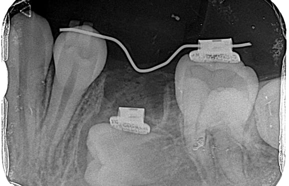 藤沢デンタルオフィスの虫歯や破折で先天性の萌出方向異常を部分矯正で治療