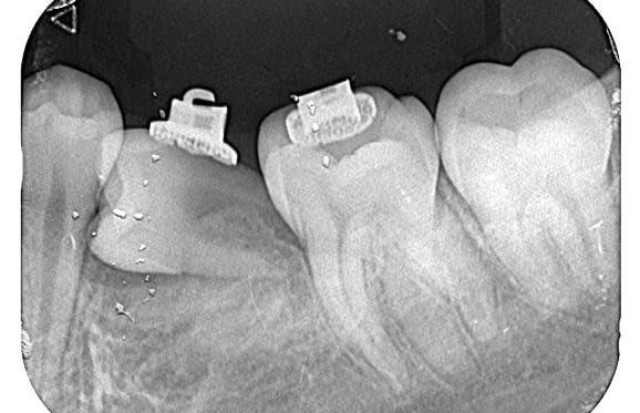 藤沢デンタルオフィスの虫歯や破折で先天性の萌出方向異常を部分矯正で治療