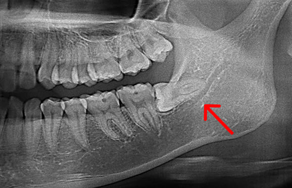 藤沢デンタルオフィスの親知らず抜歯