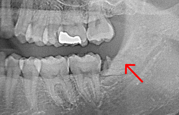 藤沢デンタルオフィスの親知らず抜歯