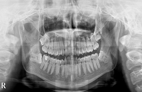 藤沢デンタルオフィスの親知らず抜歯
