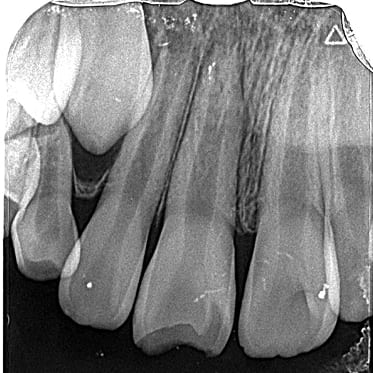 藤沢デンタルオフィスの完全脱臼術後