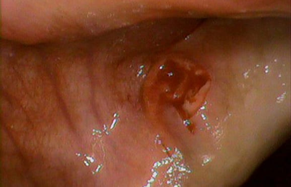 藤沢デンタルオフィスの骨隆起除去後