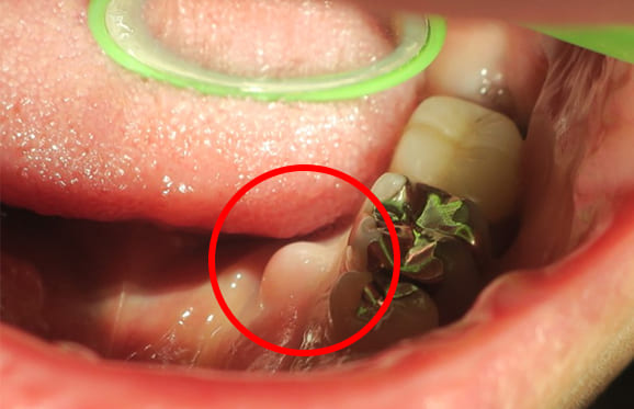 藤沢デンタルオフィスの下顎舌側の骨隆起