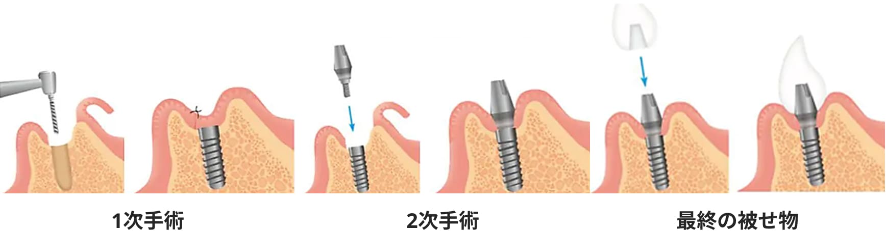 インプラントの解説図