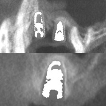 藤沢デンタルオフィスのインプラント術後