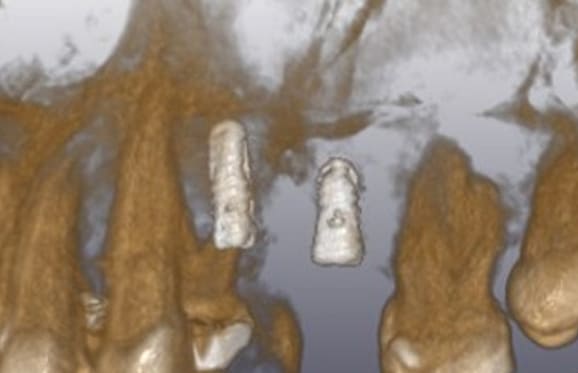 藤沢デンタルオフィスのインプラント術後