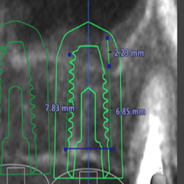 藤沢デンタルオフィスのインプラント術前