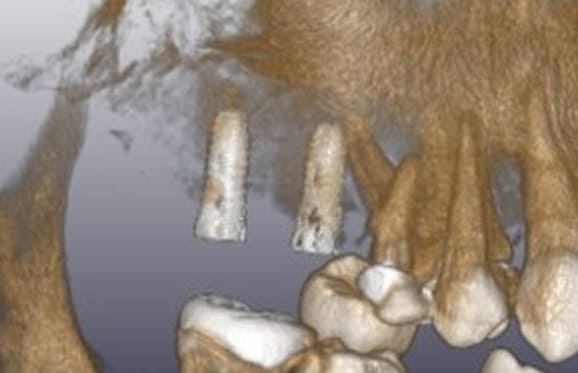 藤沢デンタルオフィスのインプラント術後