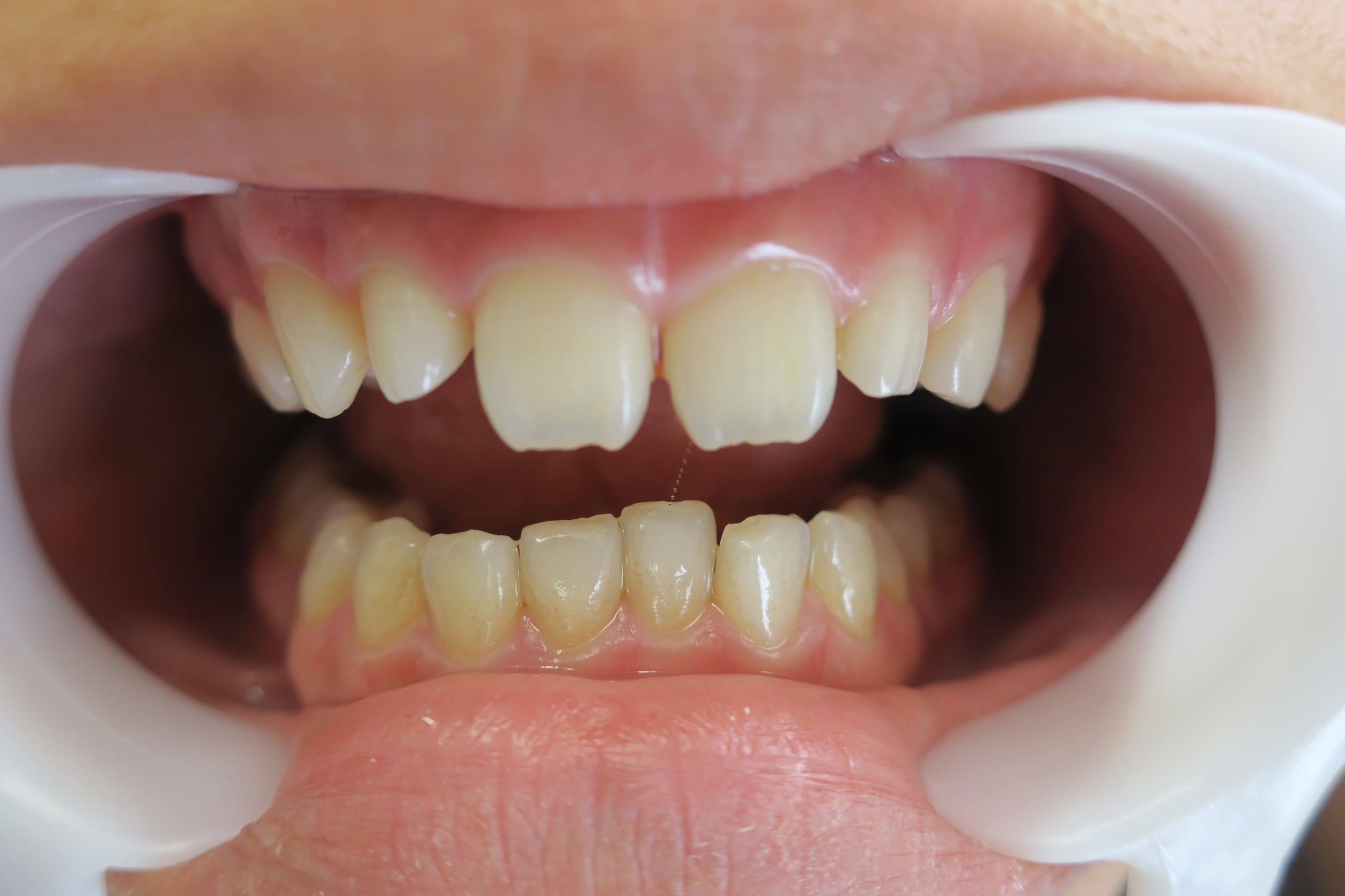 藤沢デンタルオフィスのラミネートべニア