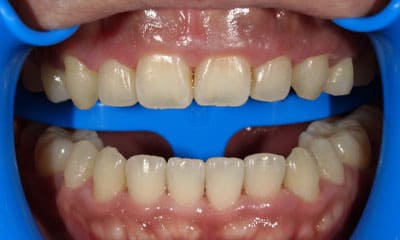 藤沢デンタルオフィスのホワイトニング術前