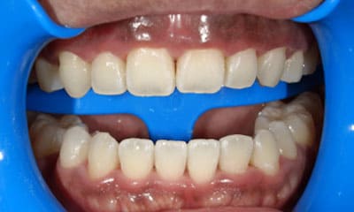 藤沢デンタルオフィスのホワイトニング術前