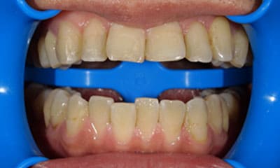 藤沢デンタルオフィスのホワイトニング術後